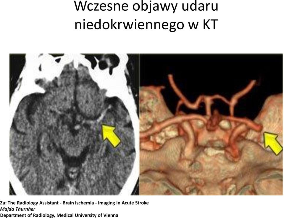 Imaging in Acute Stroke Majda Thurnher