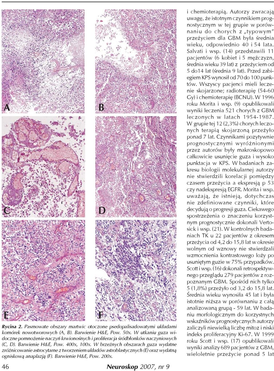 W brzeżnych obszarach guza wydatne zróżnicowanie astrocytarne z tworzeniem układów astroblastycznych (E) oraz wydatną ogniskową anaplazją (F). Barwienie H&E, Pow. 200x. 46 B D F i chemioterapią.