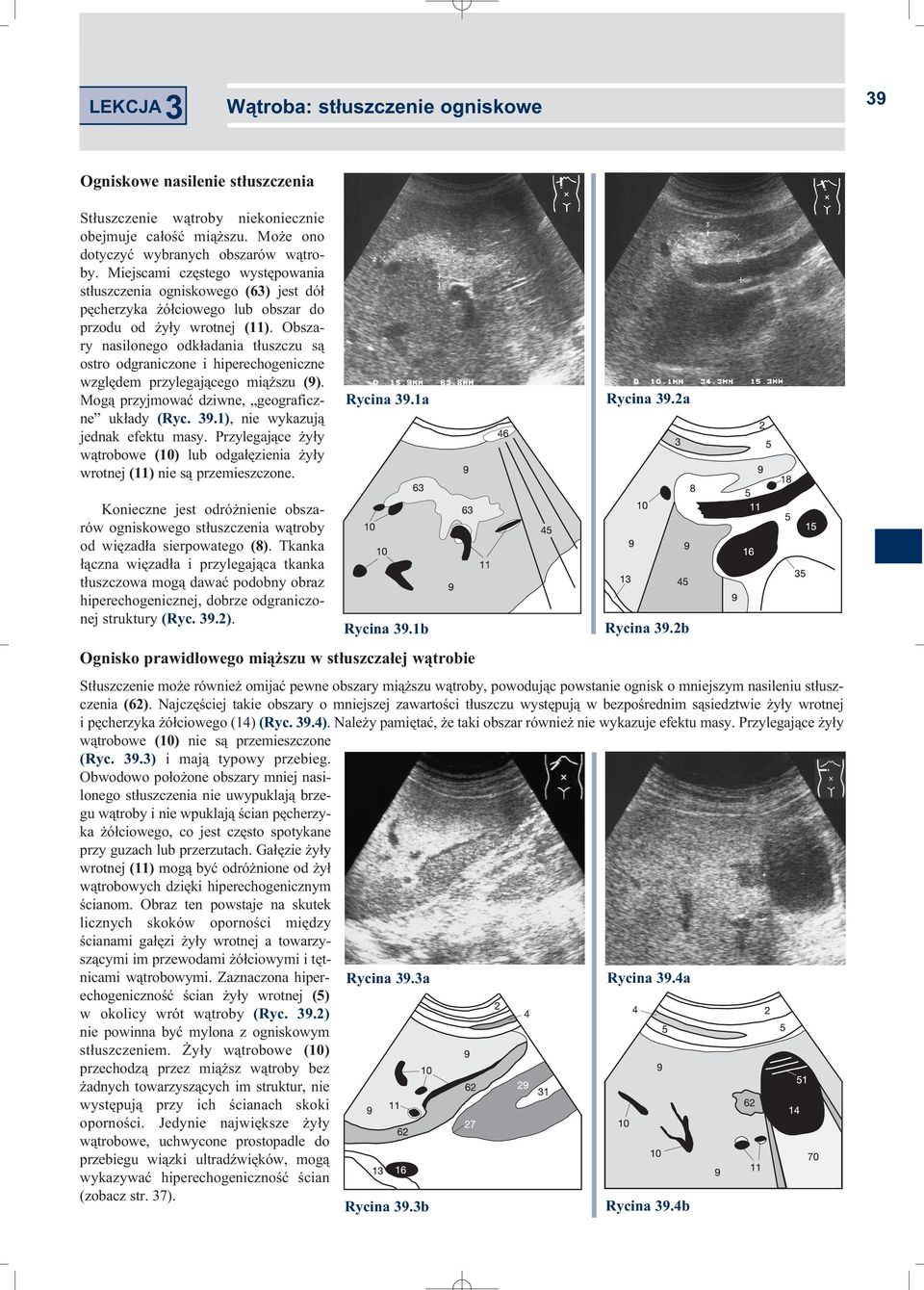 Obszary nasilonego odkładania tłuszczu są ostro odgraniczone i hiperechogeniczne względem przylegającego miąższu (9). Mogą przyjmować dziwne, geograficzne układy (Ryc. 39.