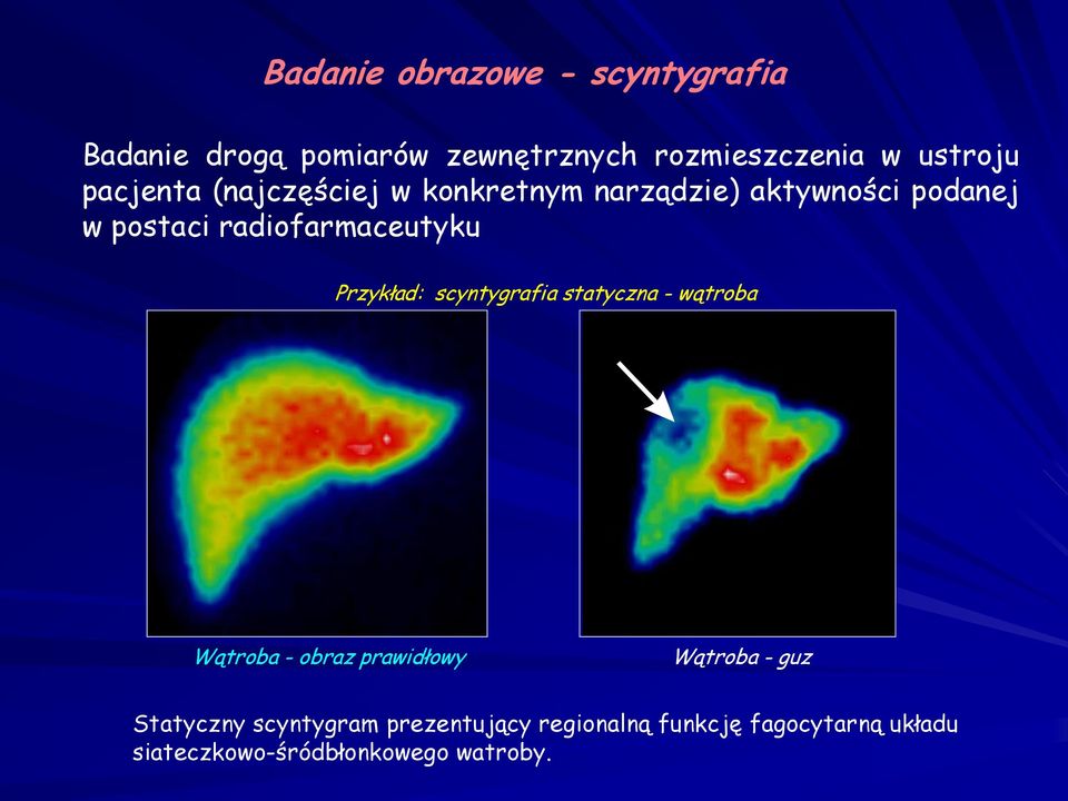 Przykład: scyntygrafia statyczna - wątroba Wątroba - obraz prawidłowy Wątroba - guz Statyczny