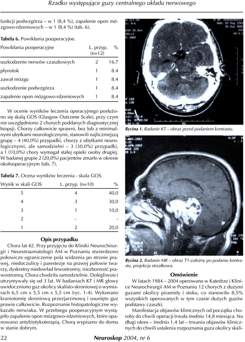 4 W ocenie wyników leczenia operacyjnego pos³u ono siê skal¹ GOS (Glasgow Outcome Scale), przy czym nie uwzglêdniono 2 chorych poddanych diagnostycznej biopsji.