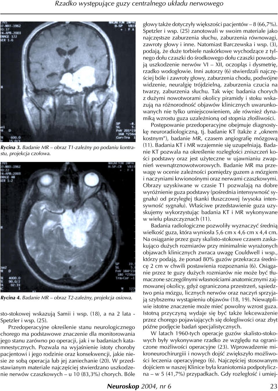 Przedoperacyjne okreœlenie stanu neurologicznego chorego ma podstawowe znaczenie dla monitorowania jego stanu zarówno po operacji, jak i w badaniach katamnestycznych.