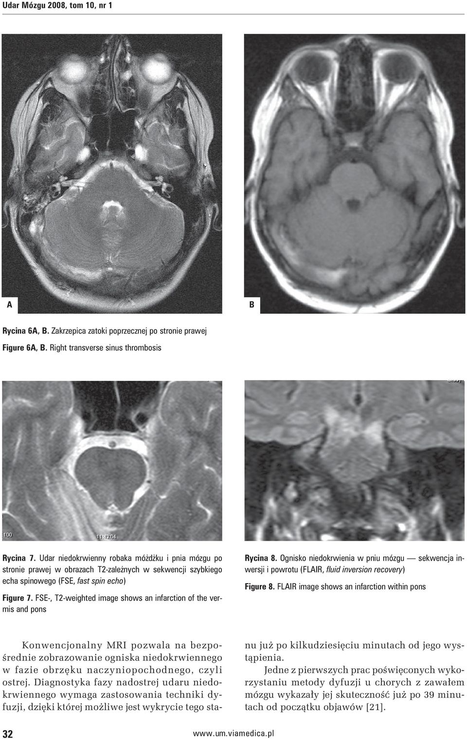 FSE-, T2-weighted image shows an infarction of the vermis and pons Rycina 8. Ognisko niedokrwienia w pniu mózgu sekwencja inwersji i powrotu (FLAIR, fluid inversion recovery) Figure 8.