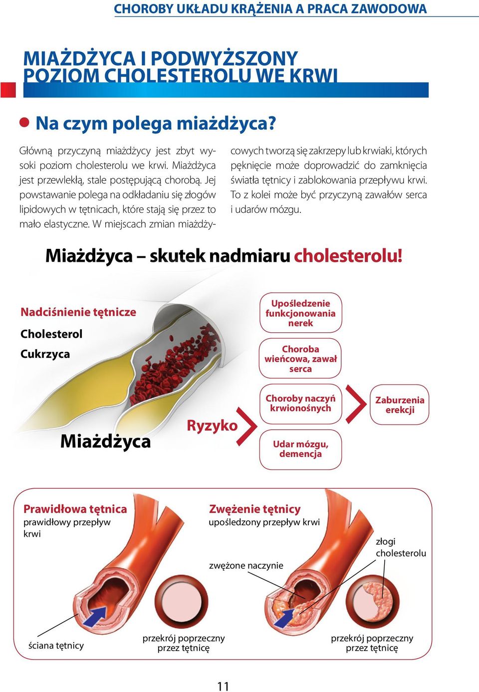 W miejscach zmian miażdżycowych tworzą się zakrzepy lub krwiaki, których pęknięcie może doprowadzić do zamknięcia światła tętnicy i zablokowania przepływu krwi.