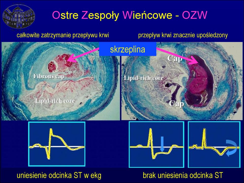 znacznie upośledzony skrzeplina