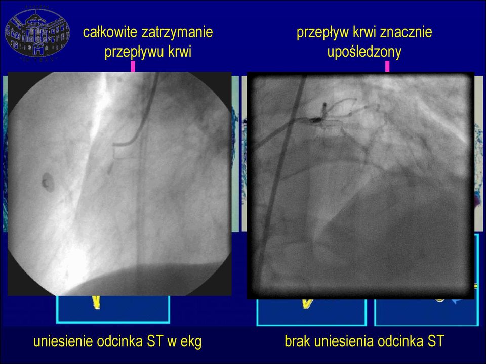 upośledzony uniesienie odcinka