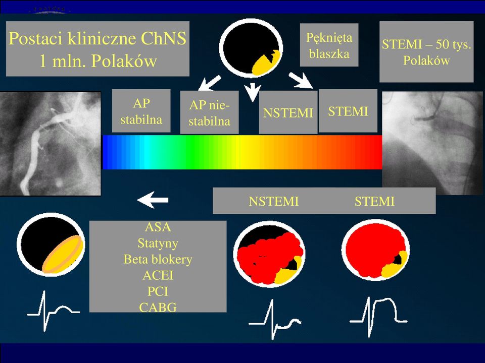 Polaków AP stabilna AP niestabilna NSTEMI