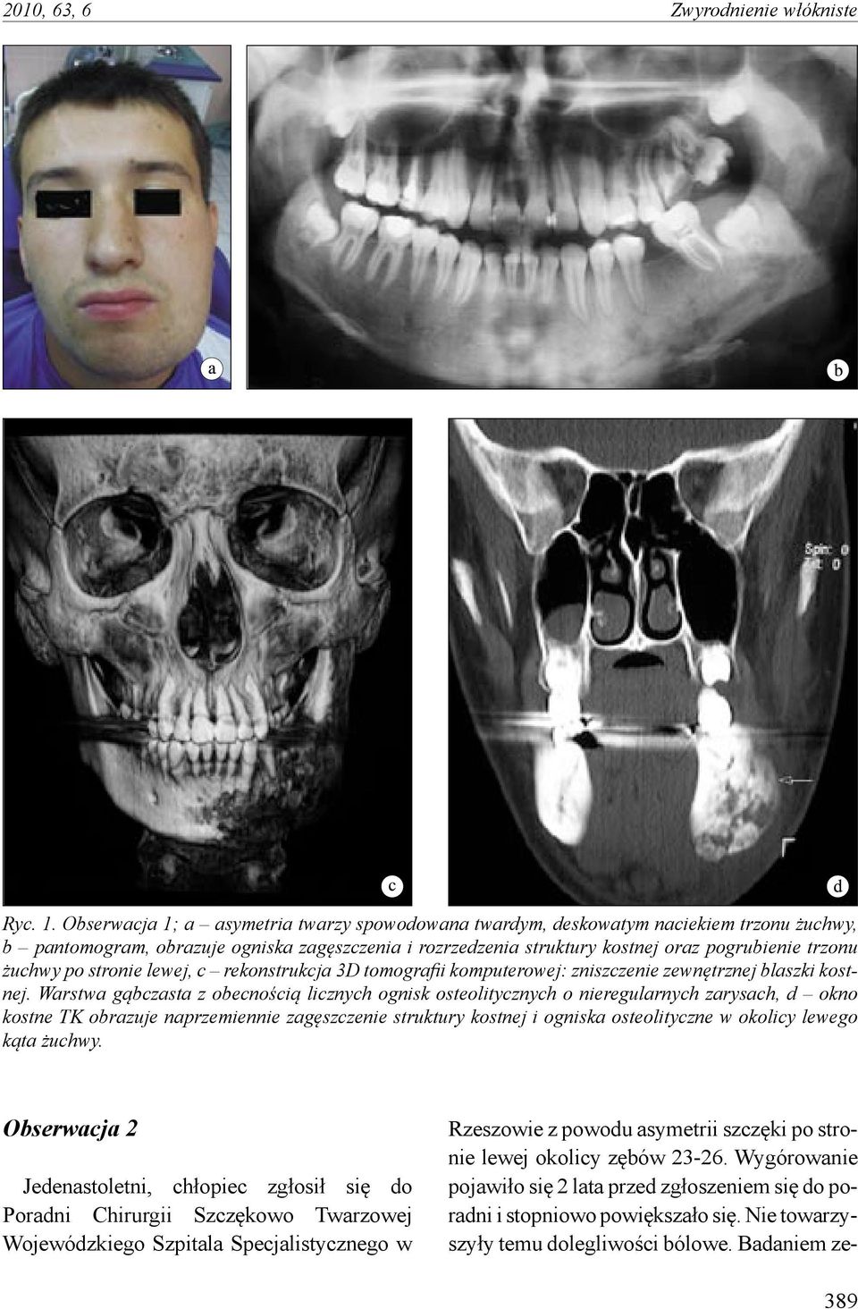 po stronie lewej, c rekonstrukcja 3D tomografii komputerowej: zniszczenie zewnętrznej blaszki kostnej.