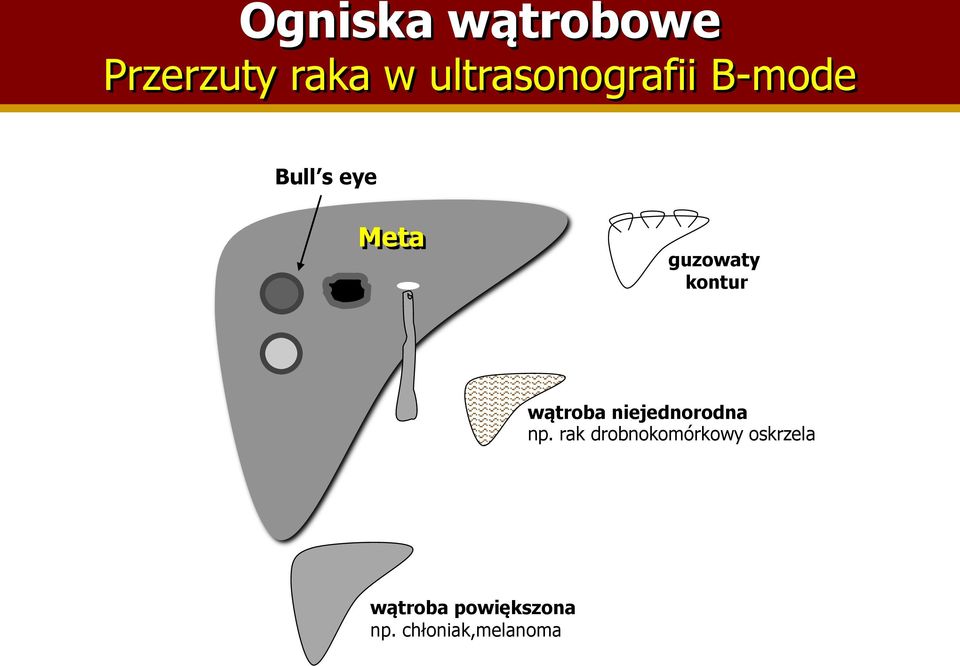 guzowaty kontur wątroba niejednorodna np.