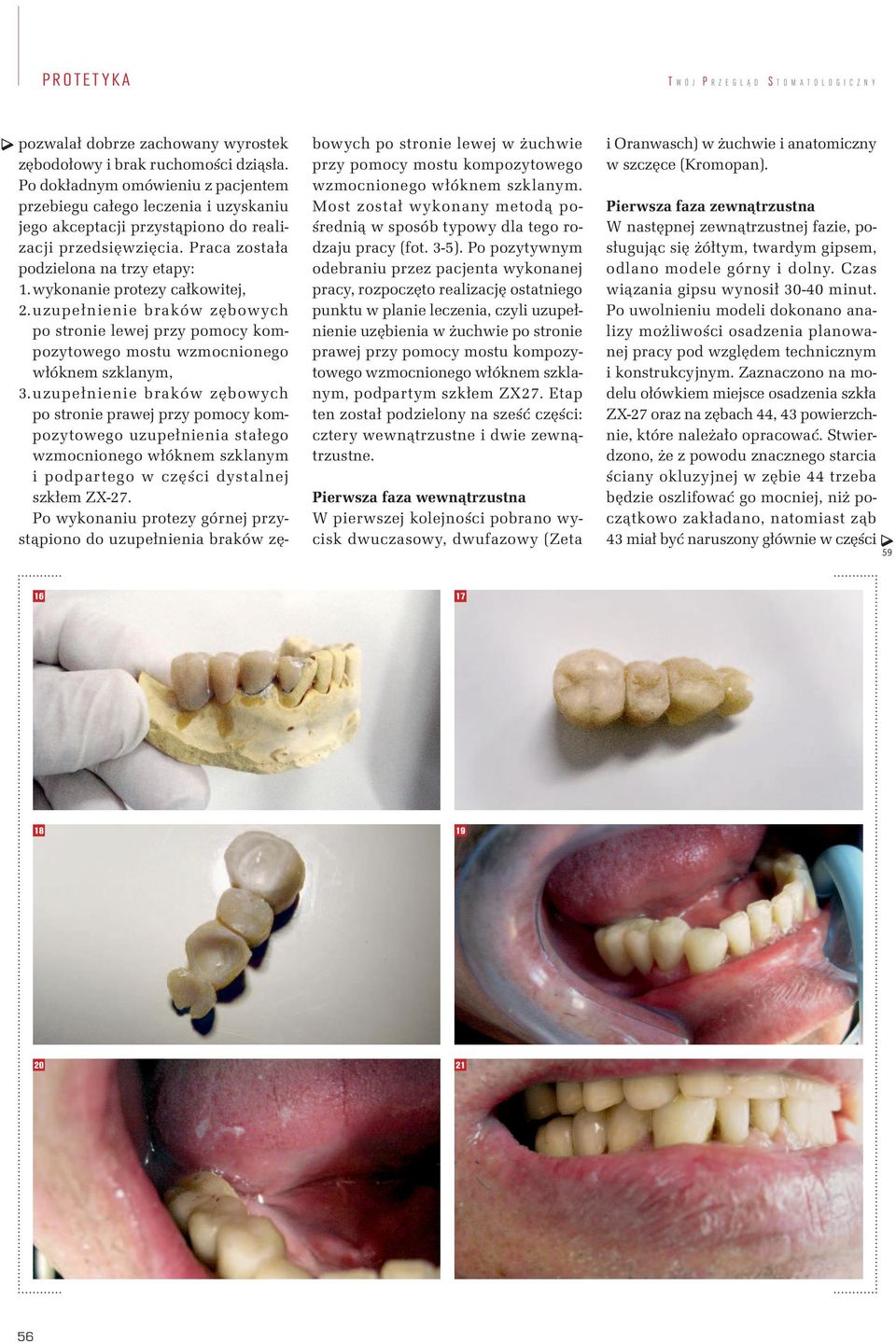 wykonanie protezy całkowitej, 2. uzupełnienie braków zębowych po stronie lewej przy pomocy kompozytowego mostu wzmocnionego włóknem szklanym, 3.
