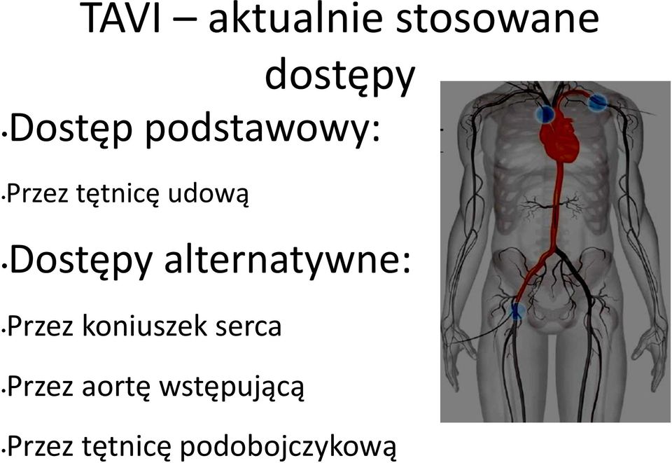 alternatywne: Przez koniuszek serca Przez