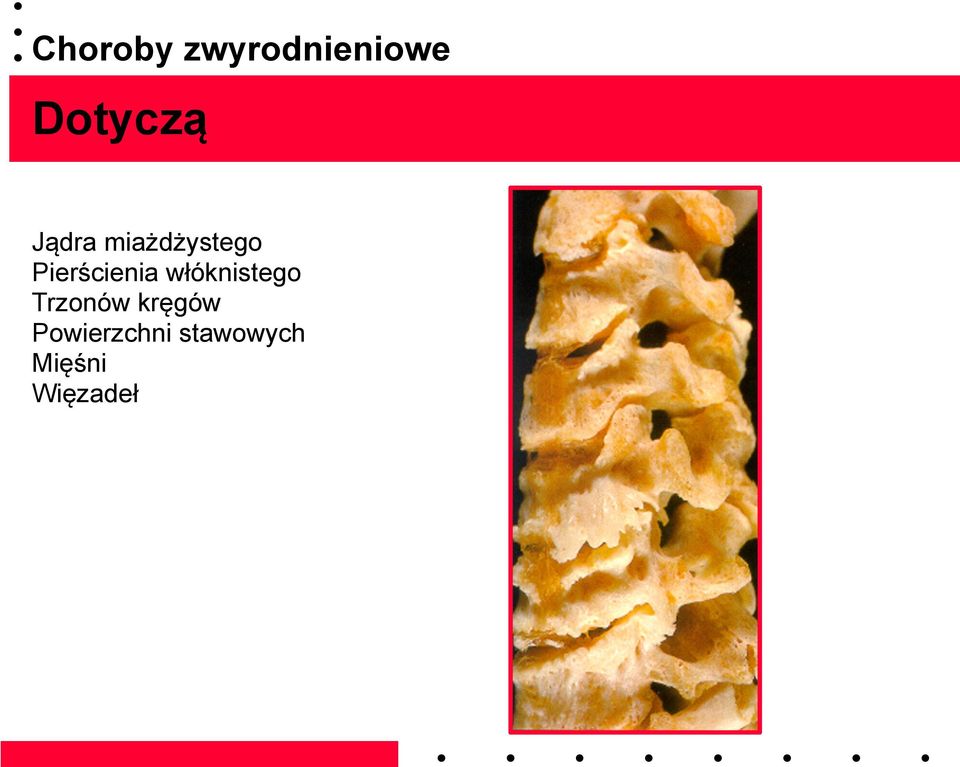 włóknistego Trzonów kręgów