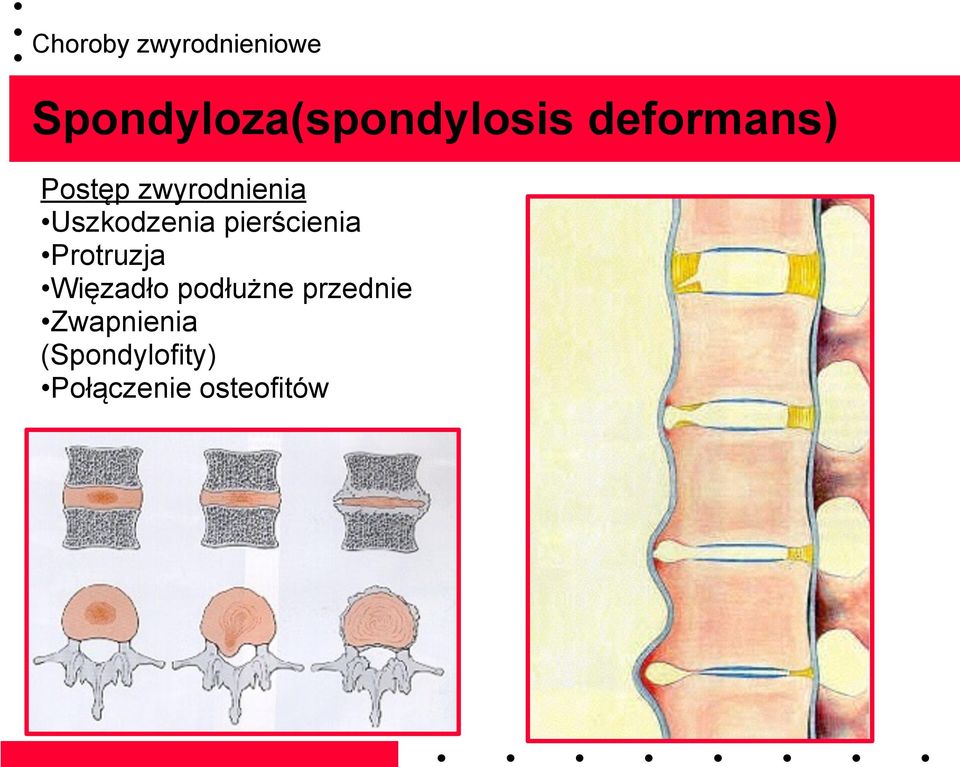 pierścienia Protruzja Więzadło podłużne