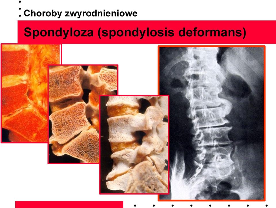 Spondyloza