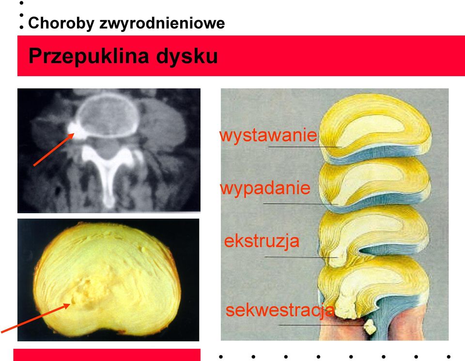 Przepuklina dysku