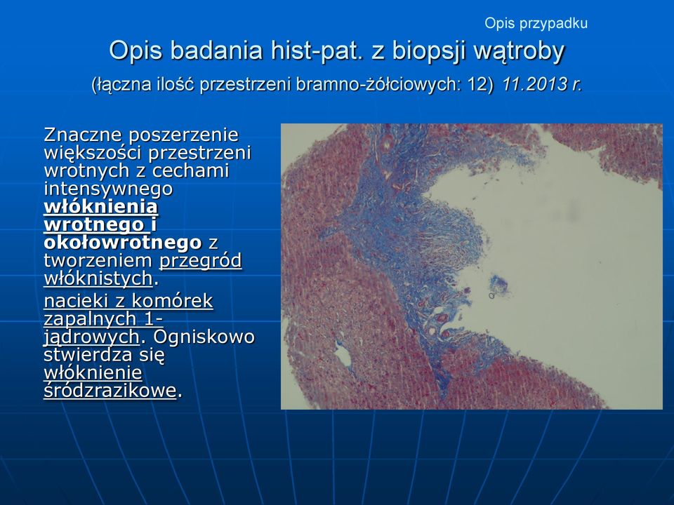 Znaczne poszerzenie większości przestrzeni wrotnych z cechami intensywnego włóknienia