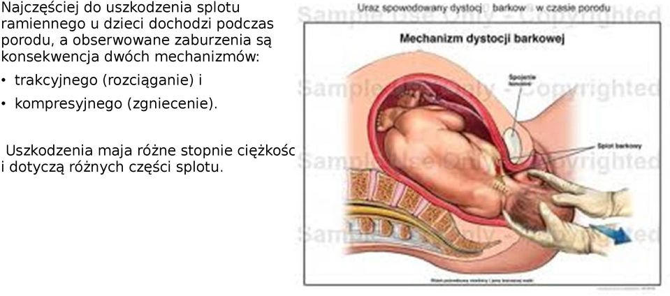 mechanizmów: trakcyjnego (rozciąganie) i kompresyjnego