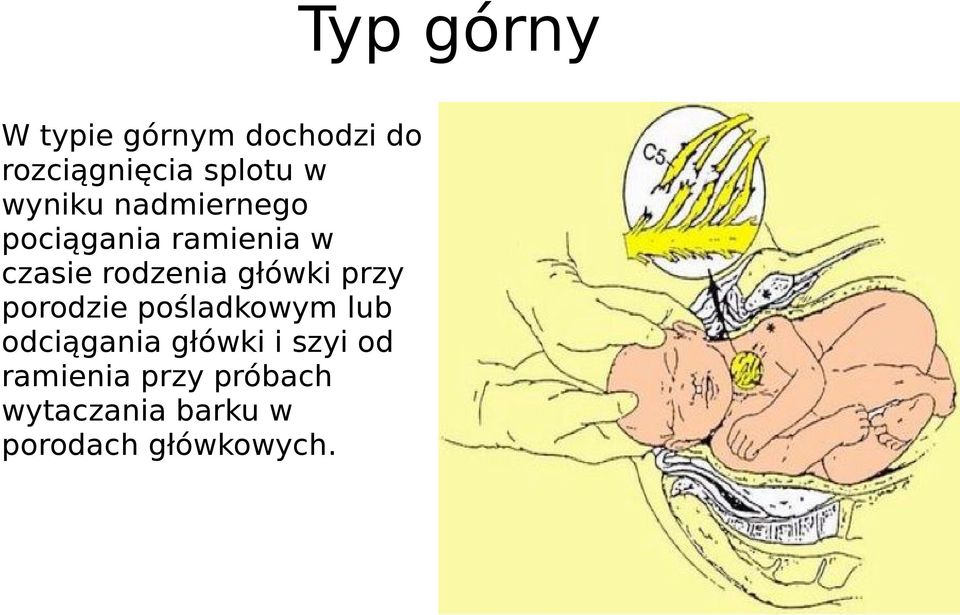 główki przy porodzie pośladkowym lub odciągania główki i