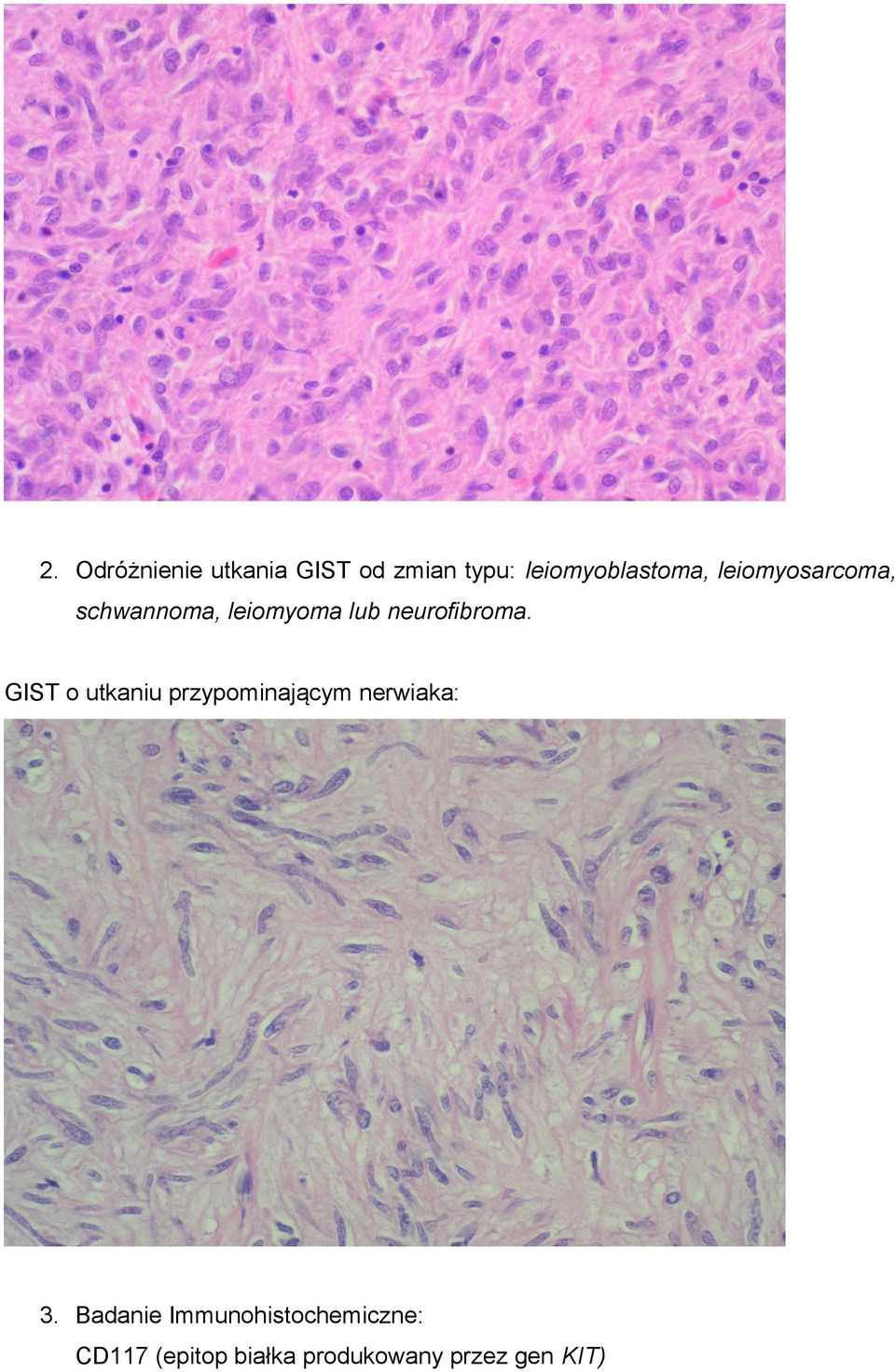 GIST o utkaniu przypominającym nerwiaka: 3.
