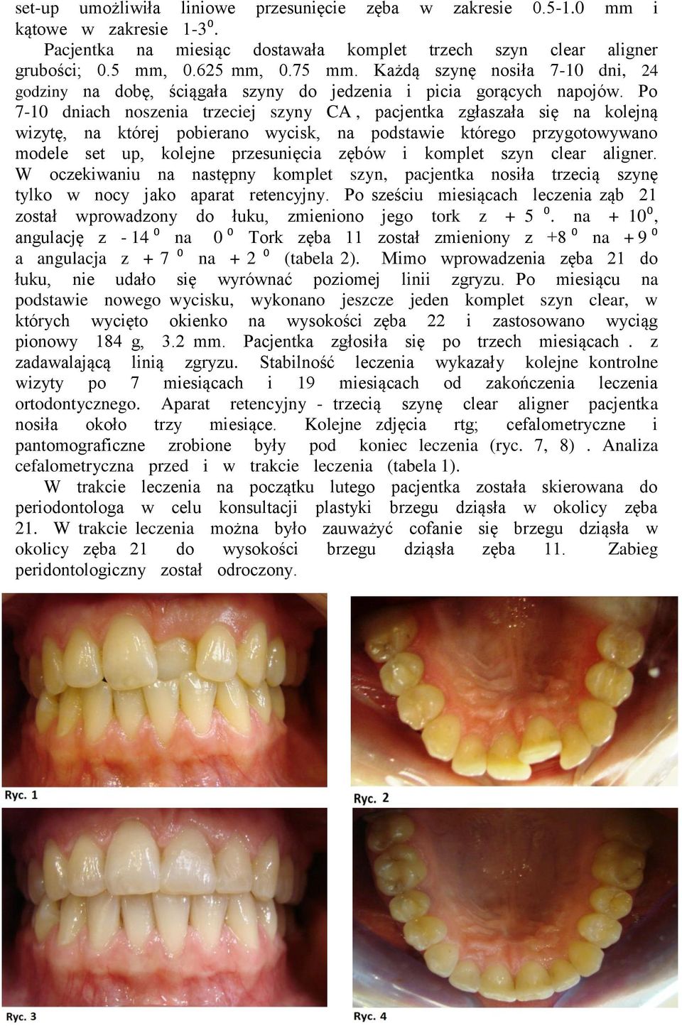 Po 7-10 dniach noszenia trzeciej szyny CA, pacjentka zgłaszała się na kolejną wizytę, na której pobierano wycisk, na podstawie którego przygotowywano modele set up, kolejne przesunięcia zębów i