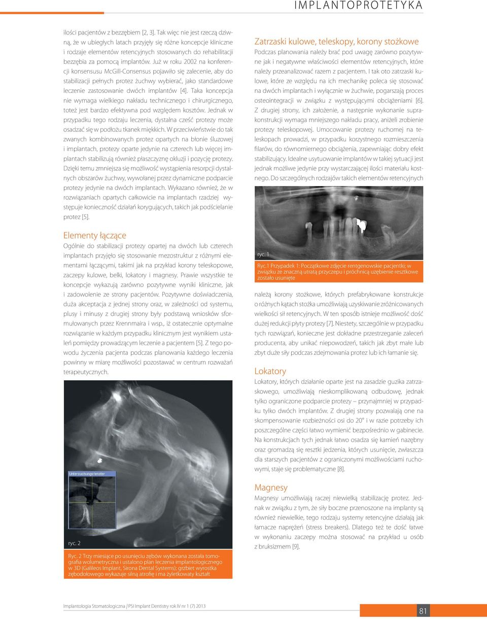 Już w roku 2002 na konferencji konsensusu McGill-Consensus pojawiło się zalecenie, aby do stabilizacji pełnych protez żuchwy wybierać, jako standardowe leczenie zastosowanie dwóch implantów [4].