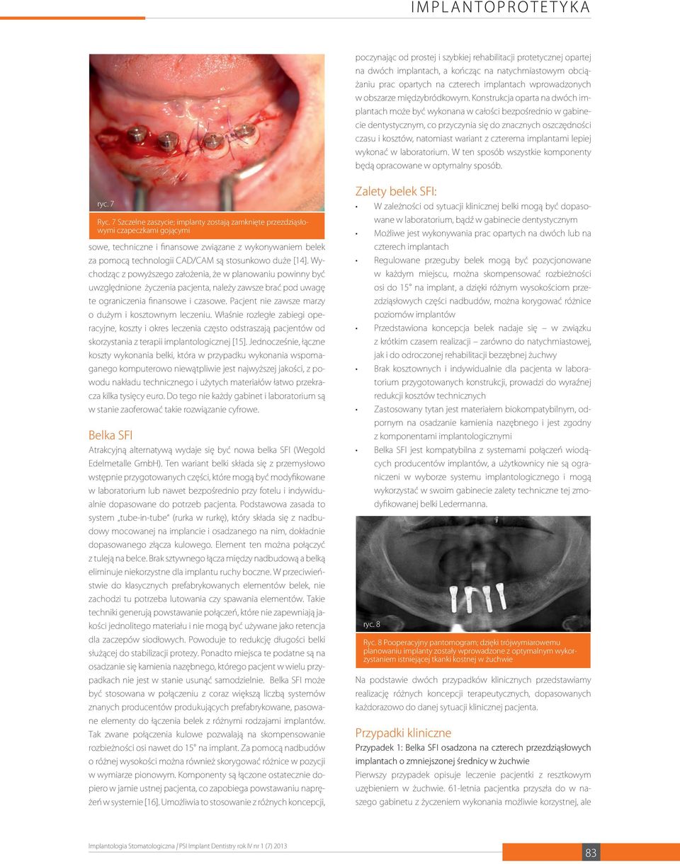 Konstrukcja oparta na dwóch implantach może być wykonana w całości bezpośrednio w gabinecie dentystycznym, co przyczynia się do znacznych oszczędności czasu i kosztów, natomiast wariant z czterema