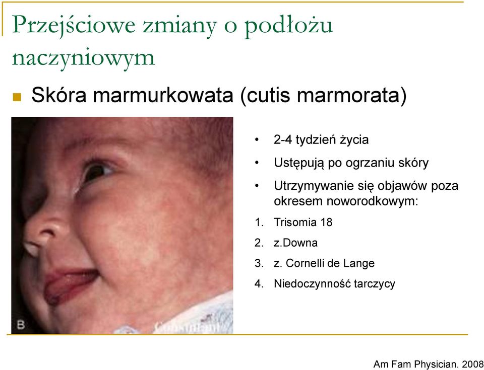 się objawów poza okresem noworodkowym: 1. Trisomia 18 2. z.downa 3.