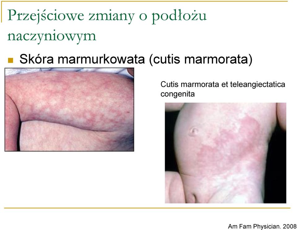 (cutis marmorata) Cutis marmorata et