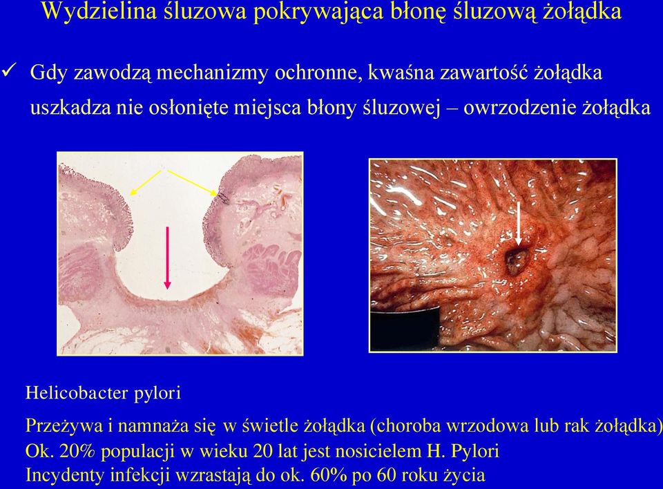 pylori Przeżywa i namnaża się w świetle żołądka (choroba wrzodowa lub rak żołądka) Ok.