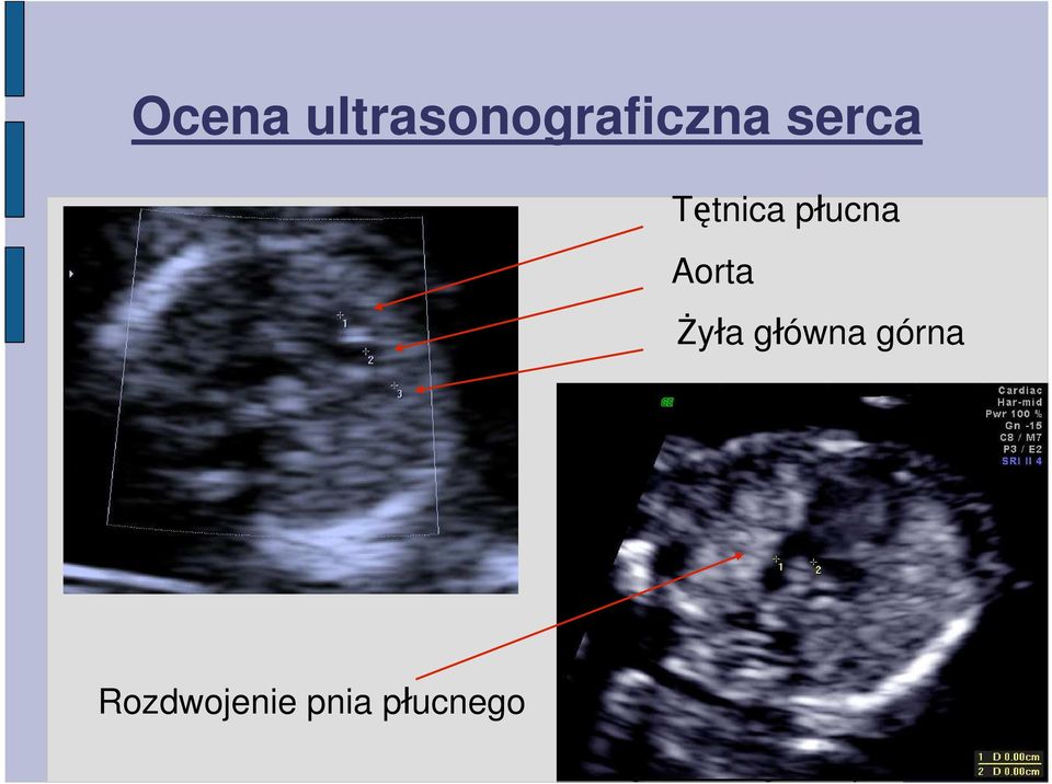 serca Tętnica płucna