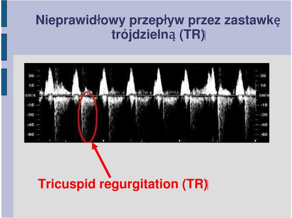 zastawkę trójdzielną