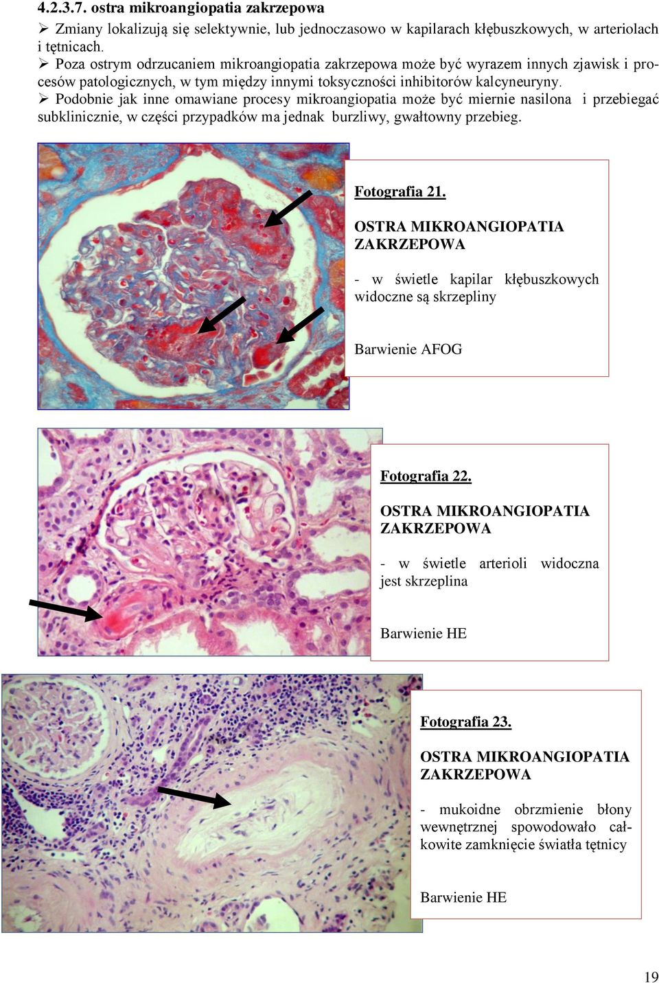 Podobnie jak inne omawiane procesy mikroangiopatia może być miernie nasilona i przebiegać subklinicznie, w części przypadków ma jednak burzliwy, gwałtowny przebieg. Fotografia 21.