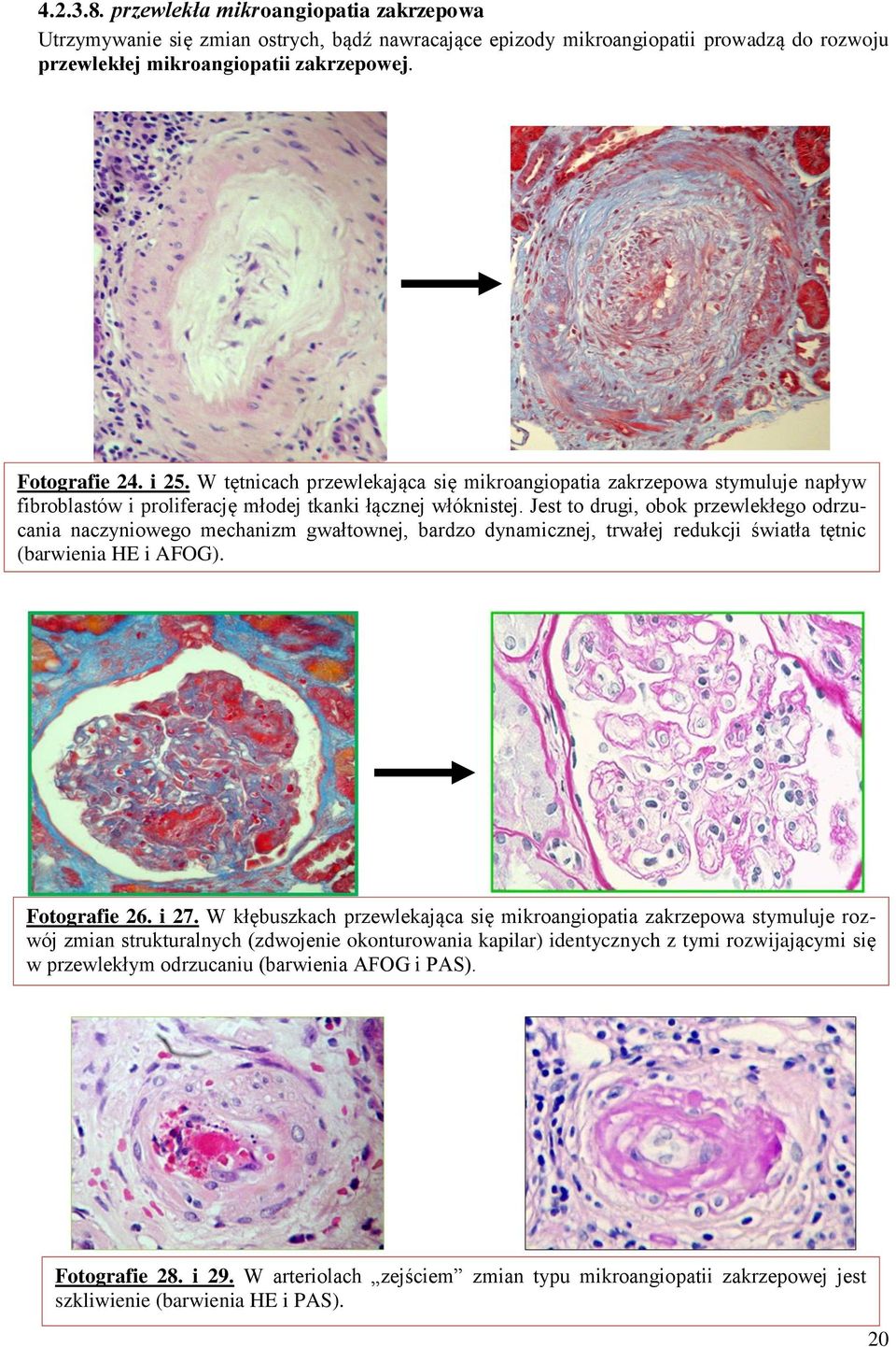 Jest to drugi, obok przewlekłego odrzucania naczyniowego mechanizm gwałtownej, bardzo dynamicznej, trwałej redukcji światła tętnic (barwienia HE i AFOG). Fotografie 26. i 27.