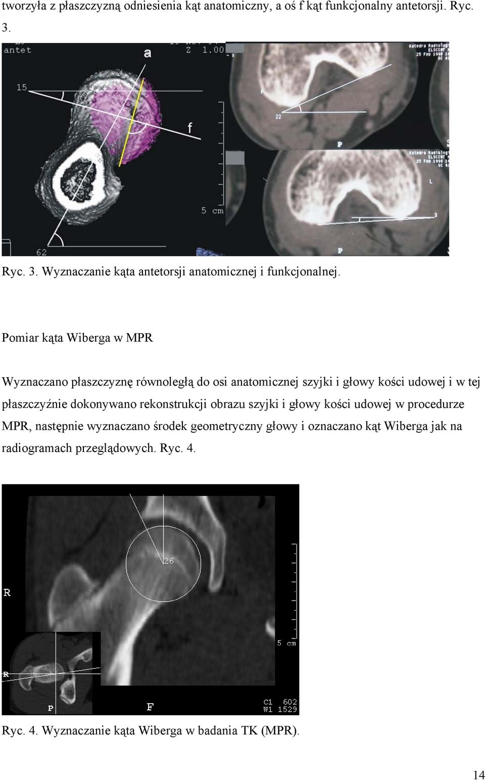 Pomiar kąta Wiberga w MPR Wyznaczano płaszczyznę równoległą do osi anatomicznej szyjki i głowy kości udowej i w tej płaszczyźnie