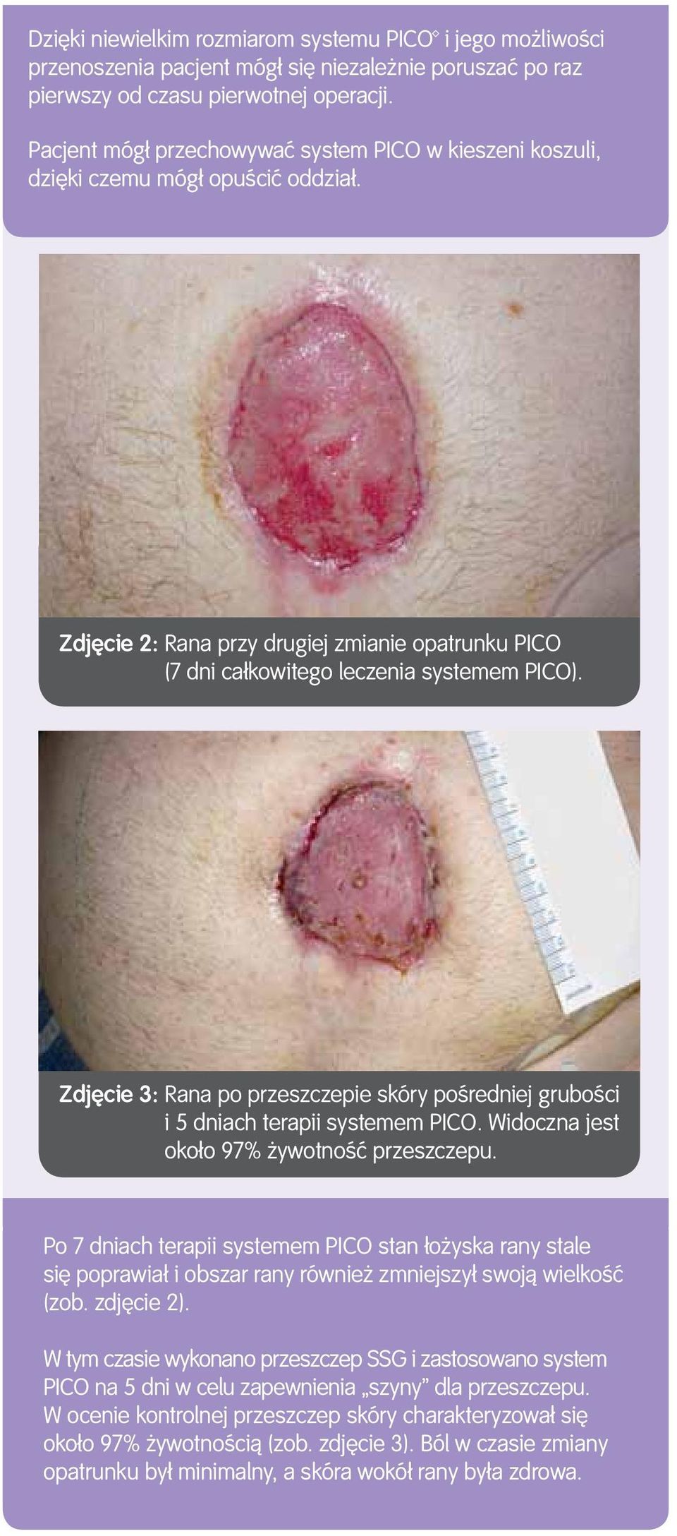 Zdjęcie 3: Rana po przeszczepie skóry pośredniej grubości i 5 dniach terapii systemem PICO. Widoczna jest około 97% żywotność przeszczepu.