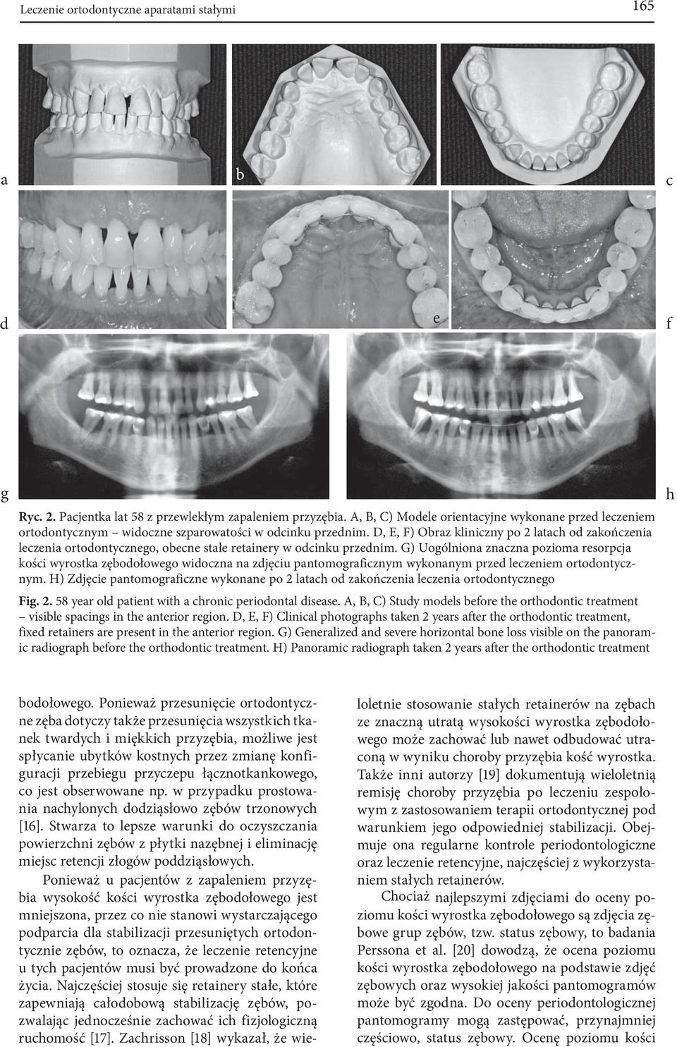 D, E, F) Obraz kliniczny po 2 latach od zakończenia leczenia ortodontycznego, obecne stałe retainery w odcinku przednim.