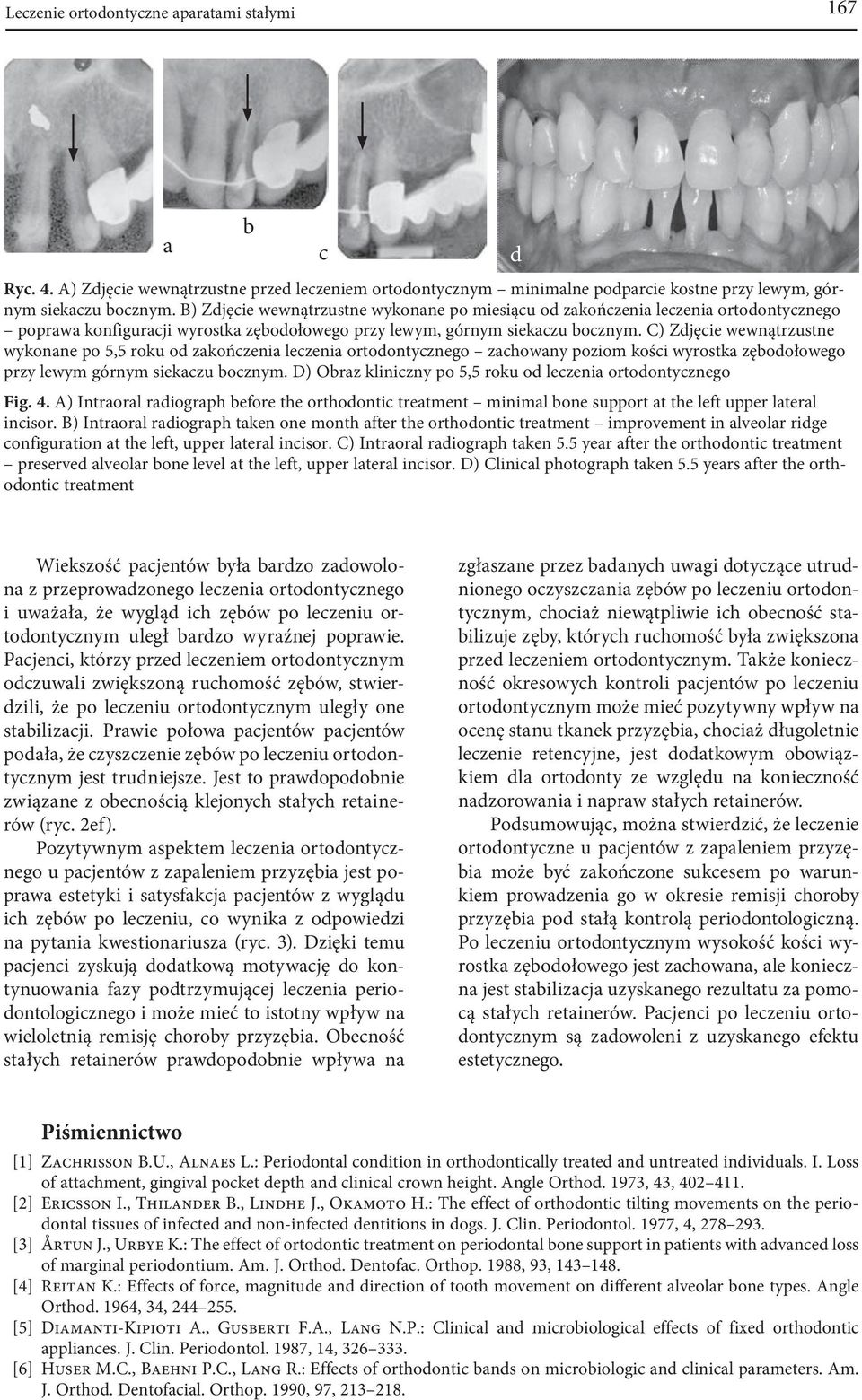 C) Zdjęcie wewnątrzustne wykonane po 5,5 roku od zakończenia leczenia ortodontycznego zachowany poziom kości wyrostka zębodołowego przy lewym górnym siekaczu bocznym.