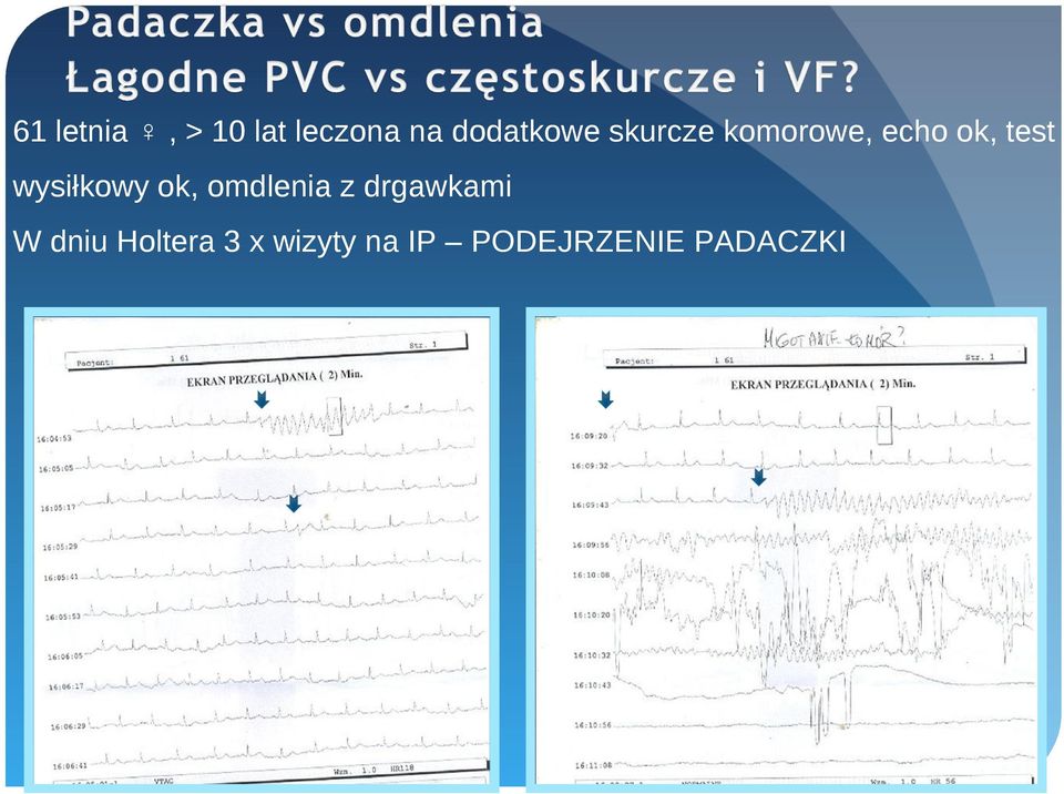 test wysiłkowy ok, omdlenia z drgawkami