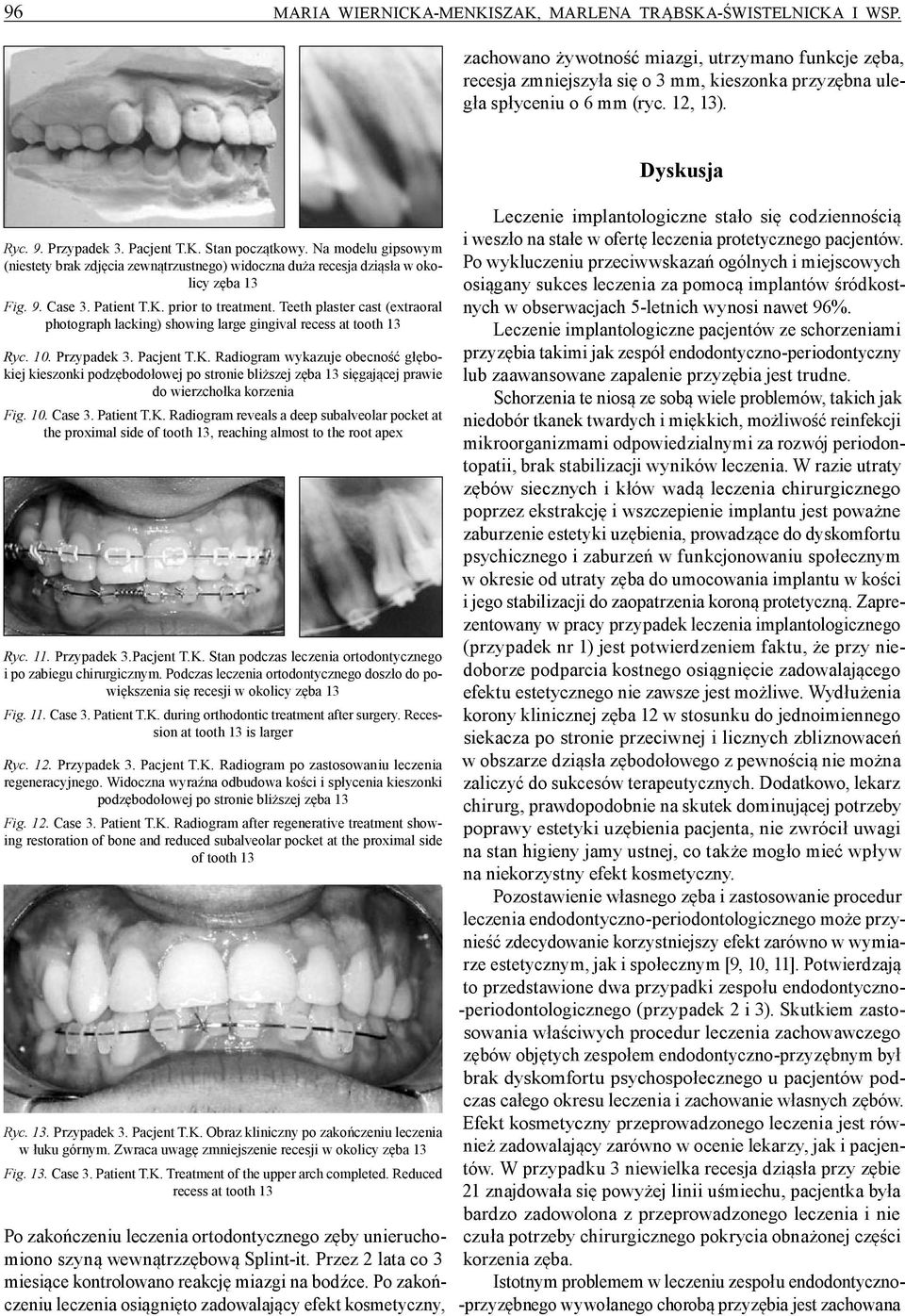 Teeth plaster cast (extraoral photograph lacking) showing large gingival recess at tooth 13 Ryc. 10. Przypadek 3. Pacjent T.K.