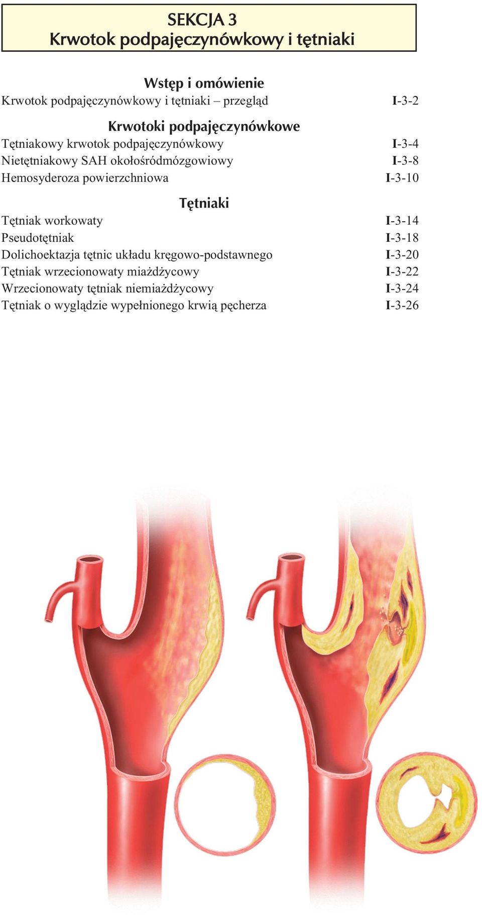 Tętniaki Tętniak workowaty Pseudotętniak Dolichoektazja tętnic układu kręgowo-podstawnego Tętniak wrzecionowaty miażdżycowy