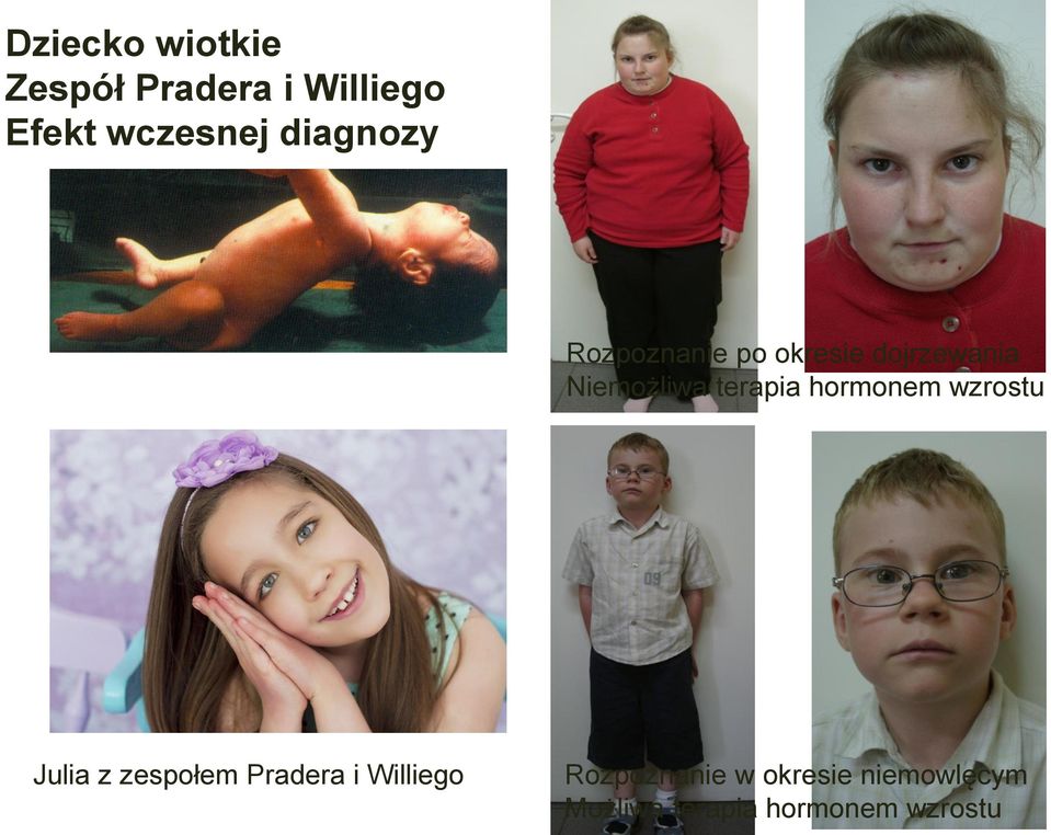 terapia hormonem wzrostu Julia z zespołem Pradera i