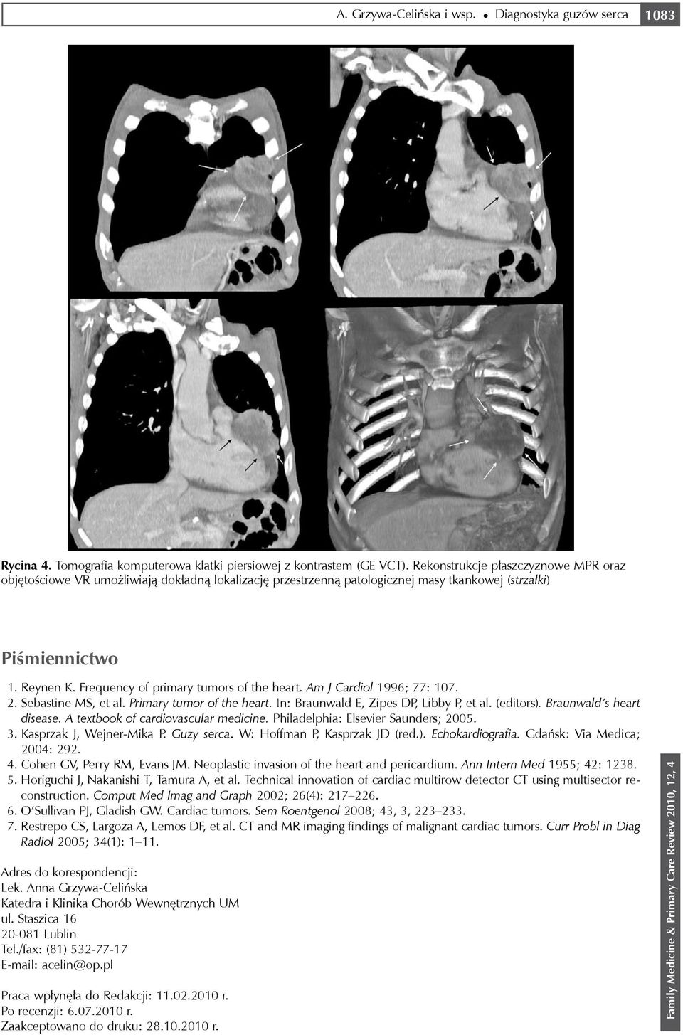 Frequency of primary tumors of the heart. Am J Cardiol 1996; 77: 107. 2. Sebastine MS, et al. Primary tumor of the heart. In: Braunwald E, Zipes DP, Libby P, et al. (editors).