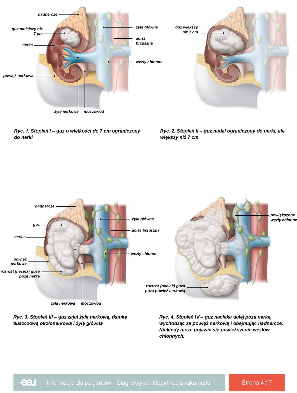 Stopień II guz nadal ograniczony do nerki, ale większy niż 7 cm nerka nadnercze guz żyła główna aorta brzuszna powiększone powięź nerkowa rozrost (naciek) guza poza nerkę