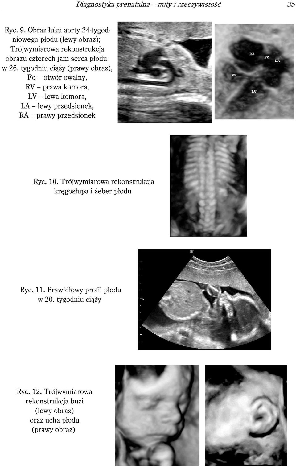 tygodniu ciąży (prawy obraz), Fo otwór owalny, RV prawa komora, LV lewa komora, LA lewy przedsionek, RA prawy przedsionek