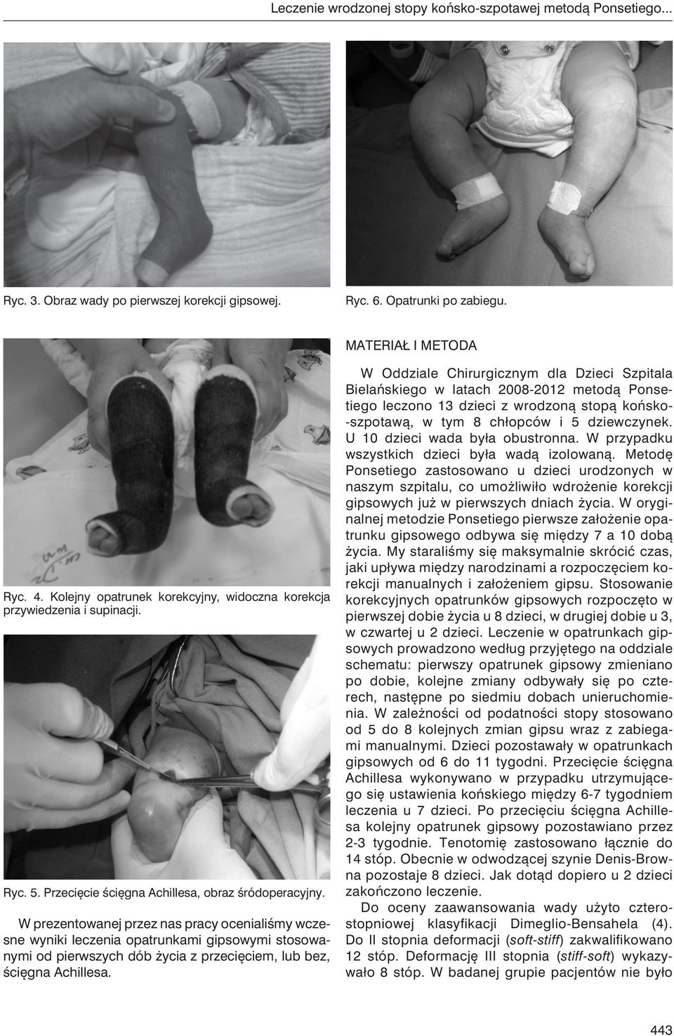 W prezentowanej przez nas pracy ocenialiśmy wczesne wyniki leczenia opatrunkami gipsowymi stosowanymi od pierwszych dób życia z przecięciem, lub bez, ścięgna Achillesa.