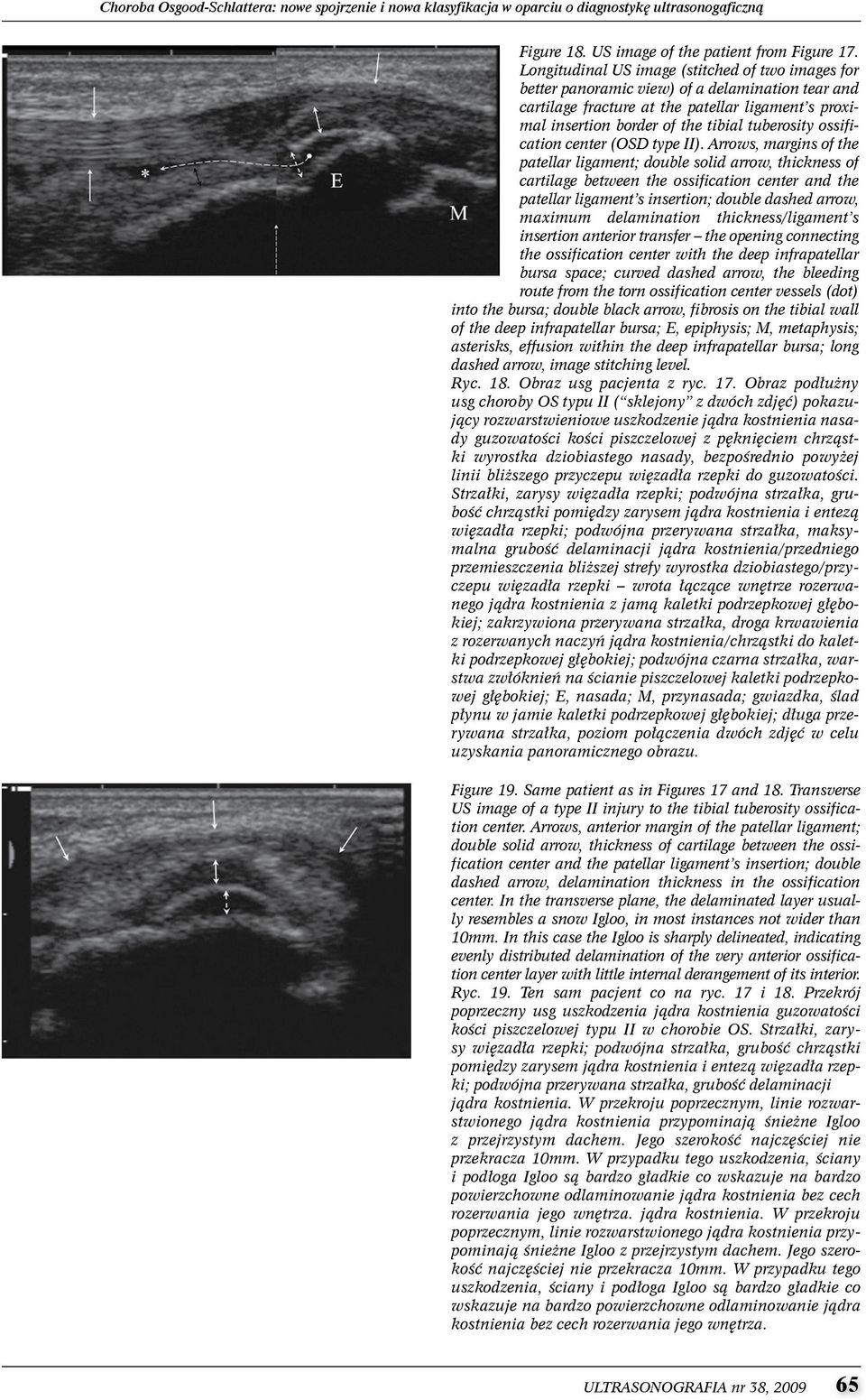 ossification center (OSD type II).