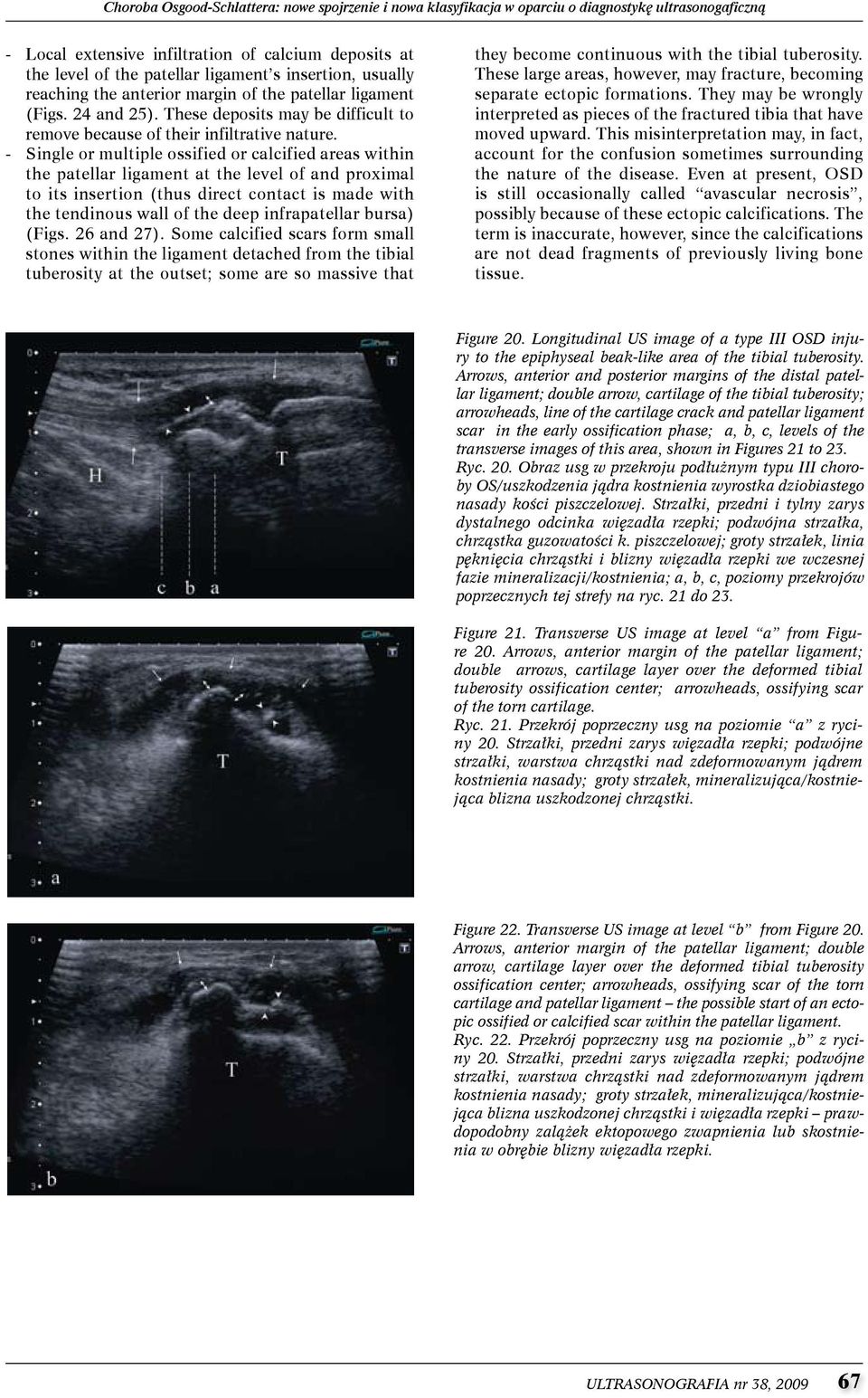 - single or multiple ossified or calcified areas within the patellar ligament at the level of and proximal to its insertion (thus direct contact is made with the tendinous wall of the deep