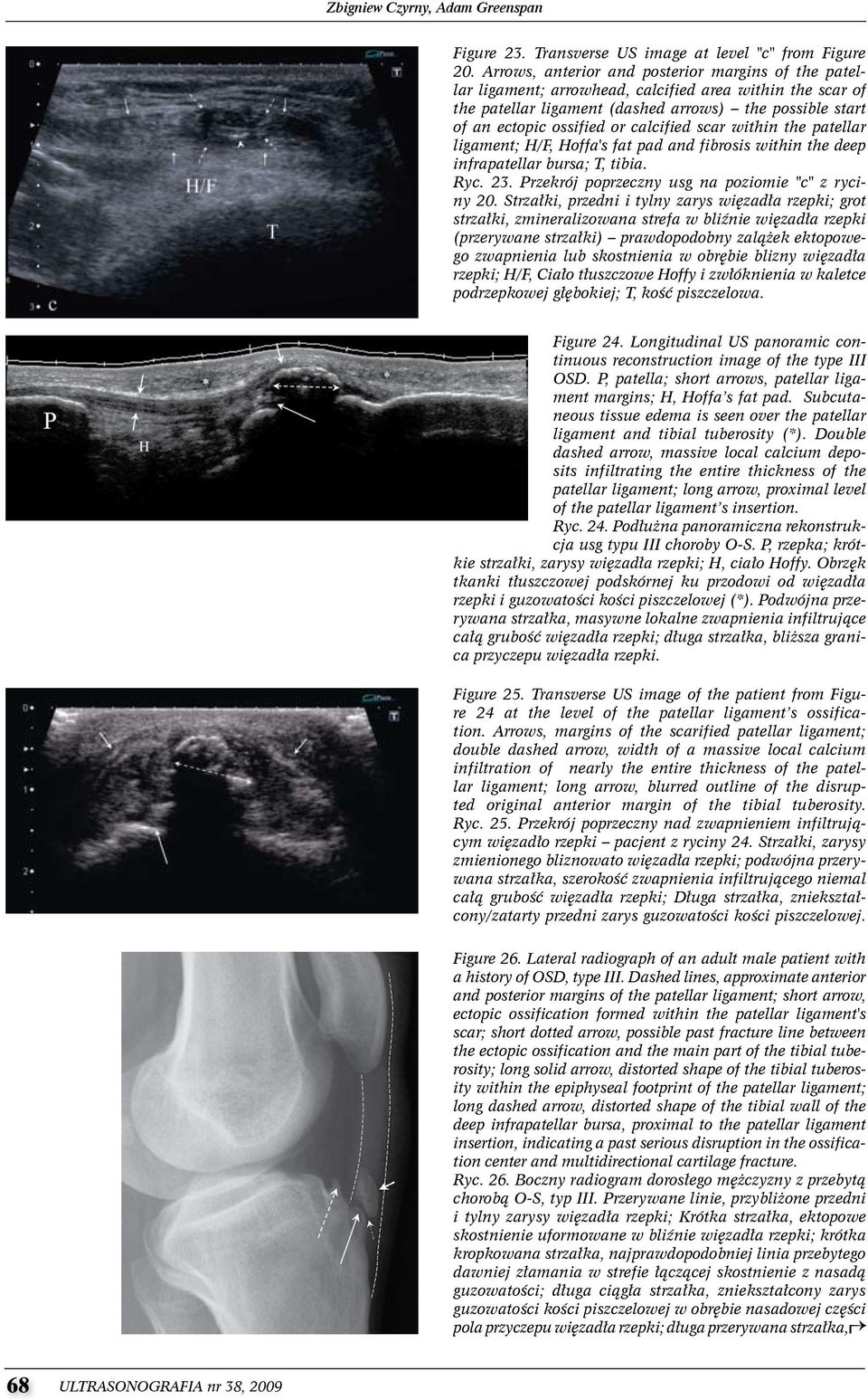 calcified scar within the patellar ligament; H/F, Hoffa's fat pad and fibrosis within the deep infrapatellar bursa; T, tibia. Ryc. 23. Przekrój poprzeczny usg na poziomie "c" z ryciny 20.