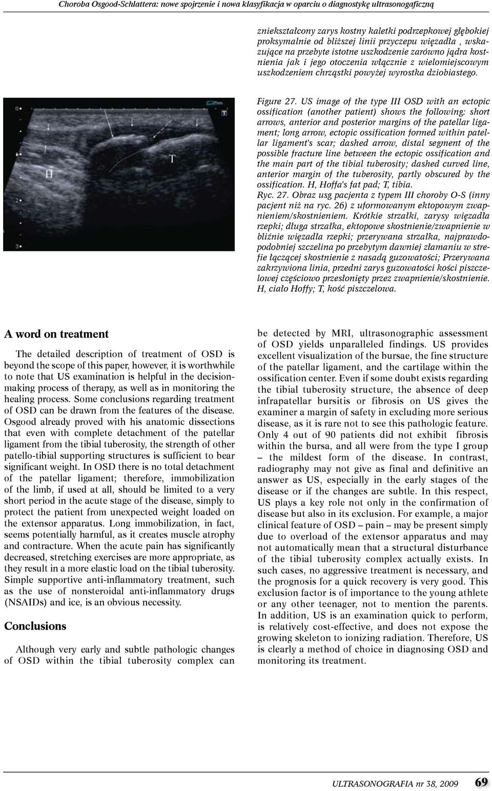 US image of the type III OSD with an ectopic ossification (another patient) shows the following: short arrows, anterior and posterior margins of the patellar ligament; long arrow, ectopic