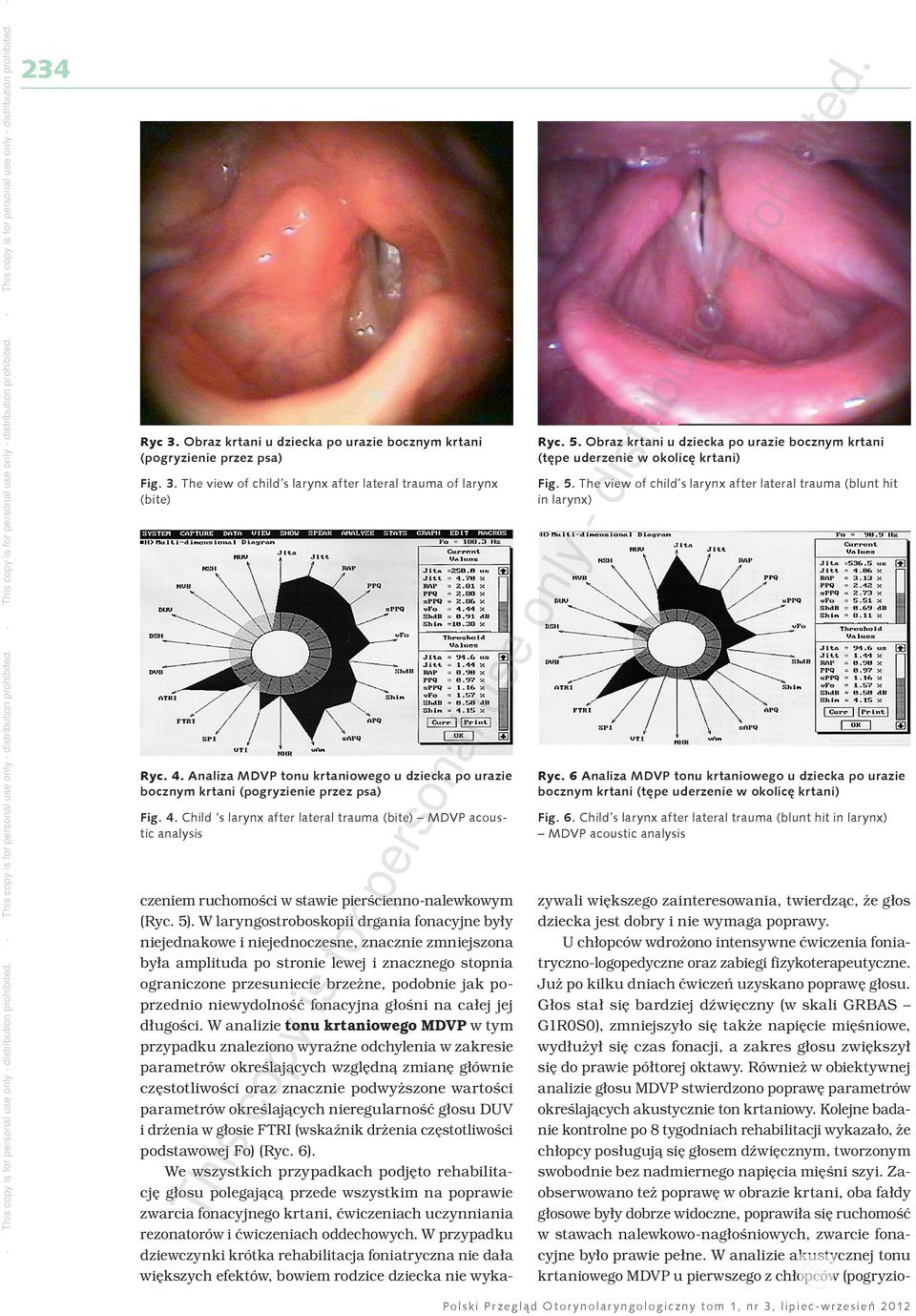Obraz krtani u dziecka po urazie bocznym krtani (tępe uderzenie w okolicę krtani) Fig. 5. The view of child s larynx after lateral trauma (blunt hit in larynx) Ryc.